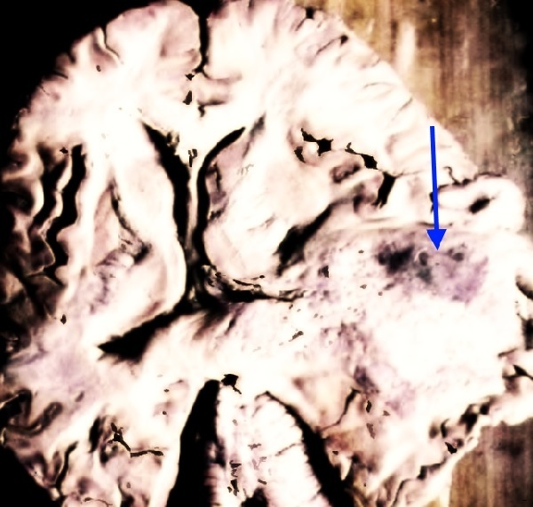 Glióm mozgu: príznaky, prognóza