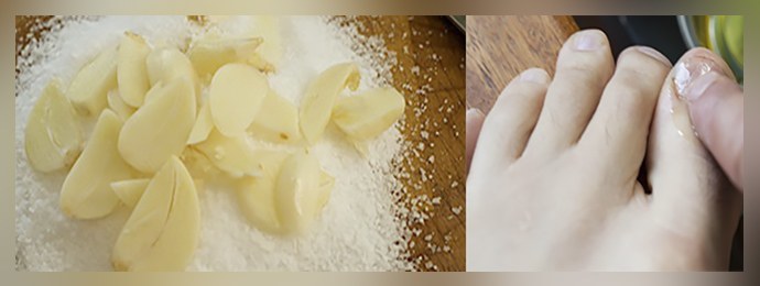 Bawang putih dari jamur kuku: ulasan, resep efektif