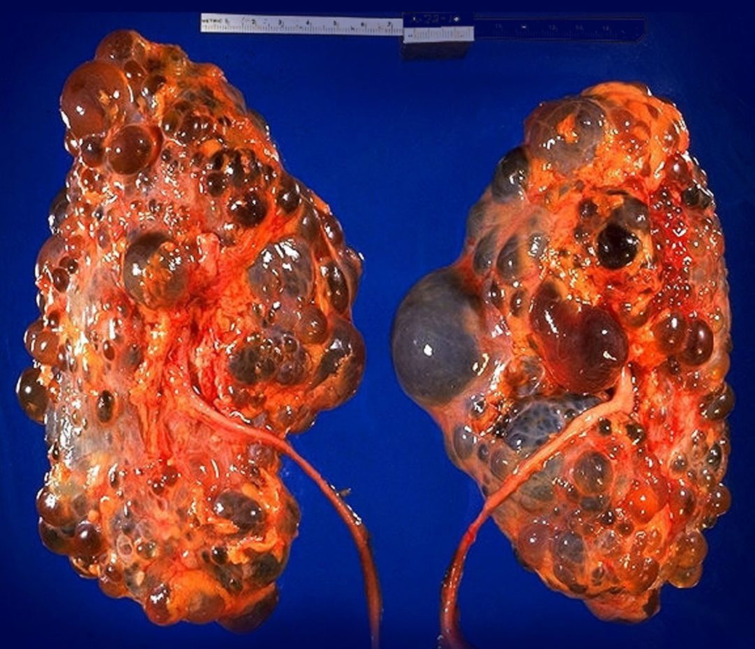 Polycystic kidney disease: what is it, symptoms, causes, treatment