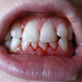 Ontsteking van tandvlees, behandeling en preventie