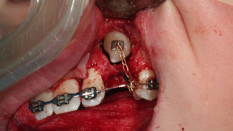 verwijdering van geïmpacteerd tanden