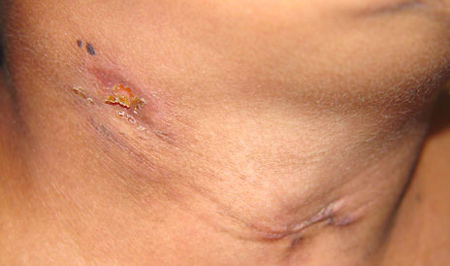 Kollikative Tuberkulose der Haut( Scrofulodermie)