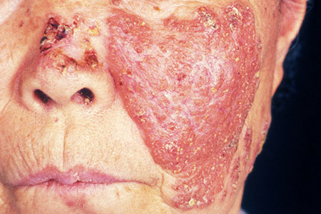 Tuberkulose des Lupus