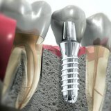 Implantiranje zuba: Pro i kontra