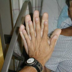 Acromegaly - neuroendocrine disease, treatment and prevention
