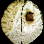 Symptomy rakoviny mozku