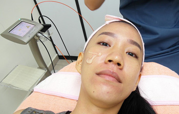 Wie wird Laser Akne entfernt?