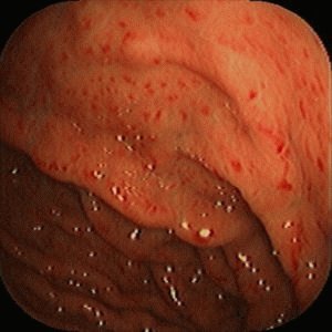 Kako se prenosi gastritis: je li moguće zaraziti se poljupcem ili nasljeđivanjem