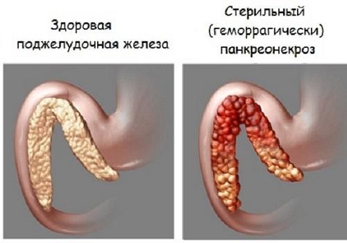 Necrose pancreática estéril