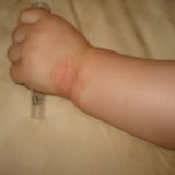 Behandling av diatese hos spedbarn