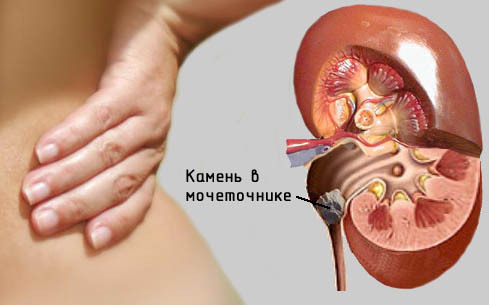 Kidney pain: causes, nature, treatment