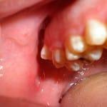 Kako za zdravljenje razjed v ustih