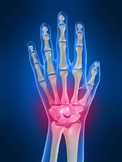 L'arthrite de l'articulation du poignet: causes, symptômes et traitement