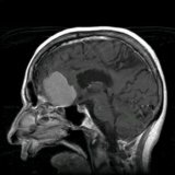 Methods of treatment of a brain tumor