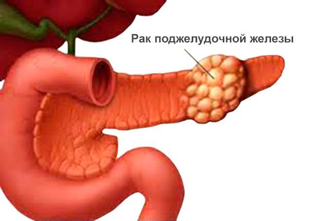 O câncer de pâncreas é de vários tipos