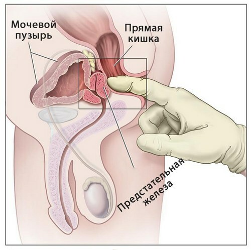 Procedure for rectal palpation of the prostate