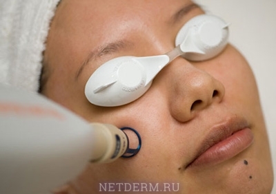 O procedimento para remoção de manchas de pigmento no rosto com um laser