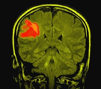 Astrocytom i hjärnan