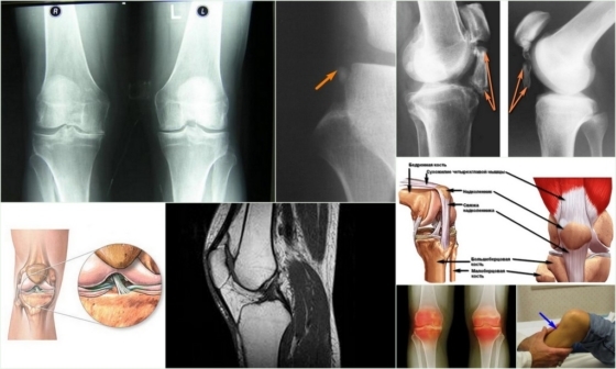 Ligamentoz rodilla - características externas de la patología