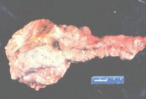 Chronische pancreatitis