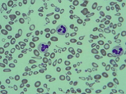 Thalassemia képek