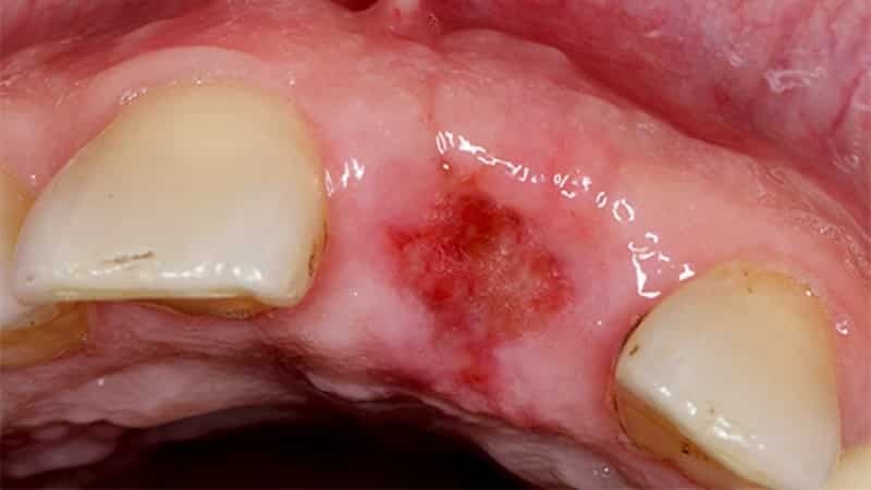 After the removal of the tooth, the gum has swollen and the swelling of the gums hurts
