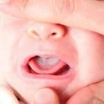 Die Behandlung von Soor im Mund eines Kindes
