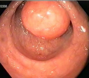 Intestinale cyste