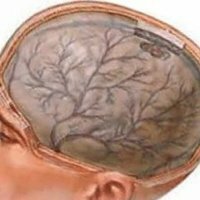 Extern hydrocephalus i hjärnan
