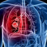Treatment for metastases of lung cancer