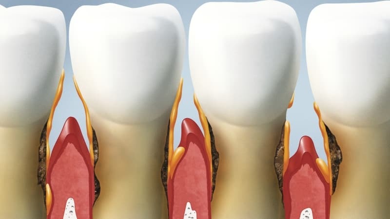 para el tratamiento de los remedios caseros de tratamiento de las enfermedades periodontales