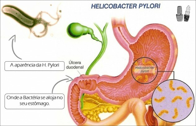 Schéma spracovania helicobacter gastritída