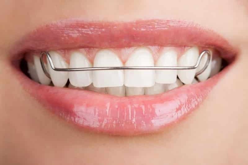 Grapas para los dientes: foto antes y después de la estructura de instalación