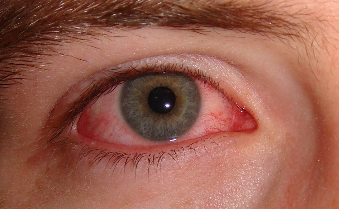 Conjunctivitis: symptoms (photo) and treatment in adults and children