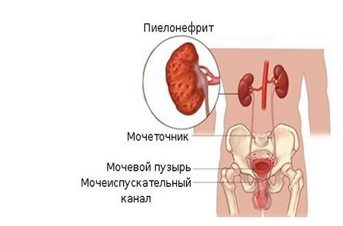 mogelijke complicaties van de nieren