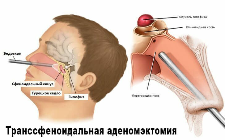 Pituitary Tumors: Symptoms, Diagnosis, Treatment