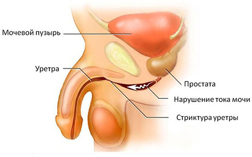 Urethrale Striktur