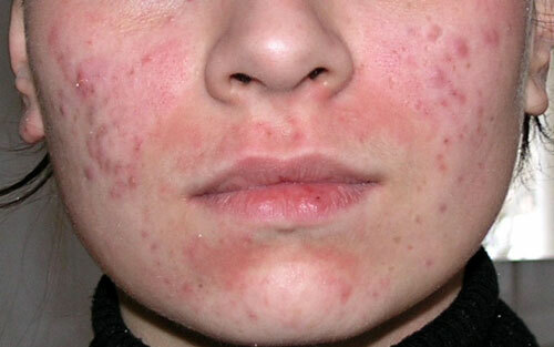 Fotografija alergija na kožu