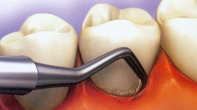 Curettage of the periodontal pocket: open and closed