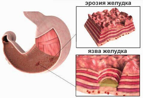 Modern methods of treatment of erosion of the stomach