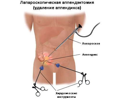Detaljer om appendicitis hos mænd: årsager, tegn og behandling