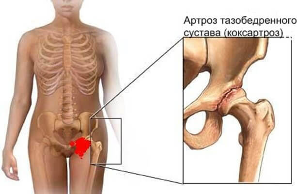 endoprotéza bedrového kĺbu: všetko o prevádzke