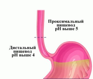 Laryngofaryngeale reflux: oorzaken, symptomen, diagnose en behandeling
