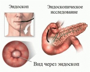 Diagnose van pancreatitis