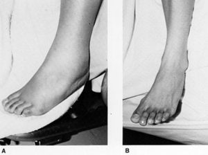 Pregnant woman's gestosis