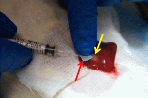Hemostatische injecties