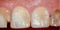 Erosion of teeth