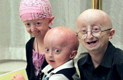 Progeria képek