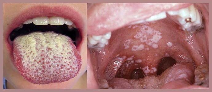 Kandydoza jamy ustnej