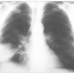 Candidiasis pneumonia, or invasive candidiasis of the lungs